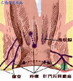 痔ろう